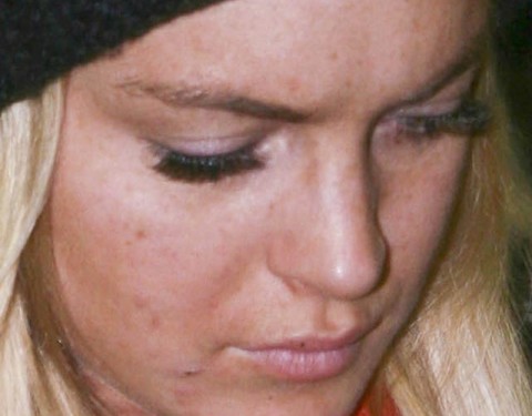 Permanent Link to Say no to vitamin B12 to keep pimples at bay lohanpop2612_800x860