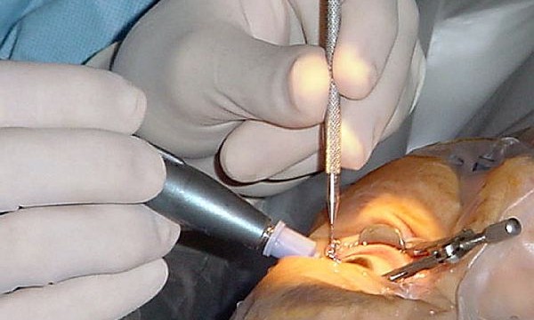 Soon, eyes to be made immune from cataract before it strikes
