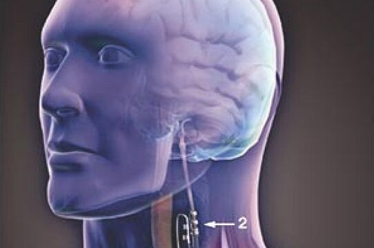 New neck nerve stimulation device could cut heart failure symptoms