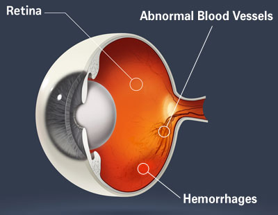 Why diabetics should have regular eye exams