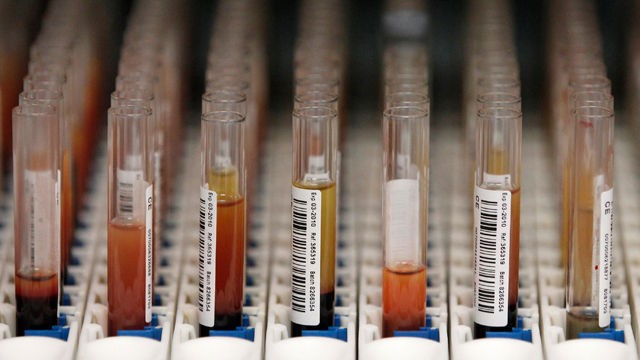World's first blood test to check fetus at risk of stillbirth developed
